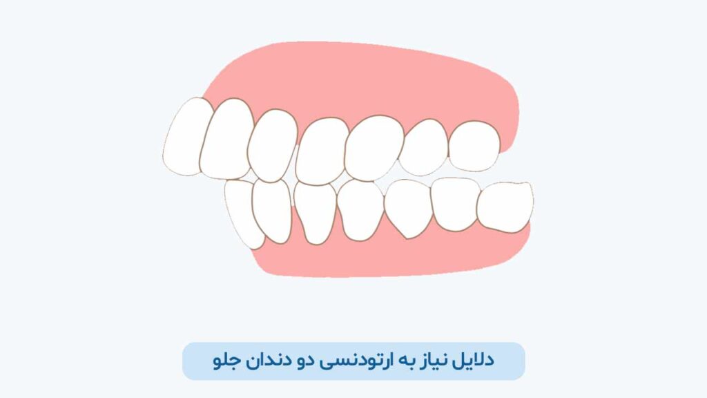 دلایل نیاز به ارتودنسی دو دندان جلو