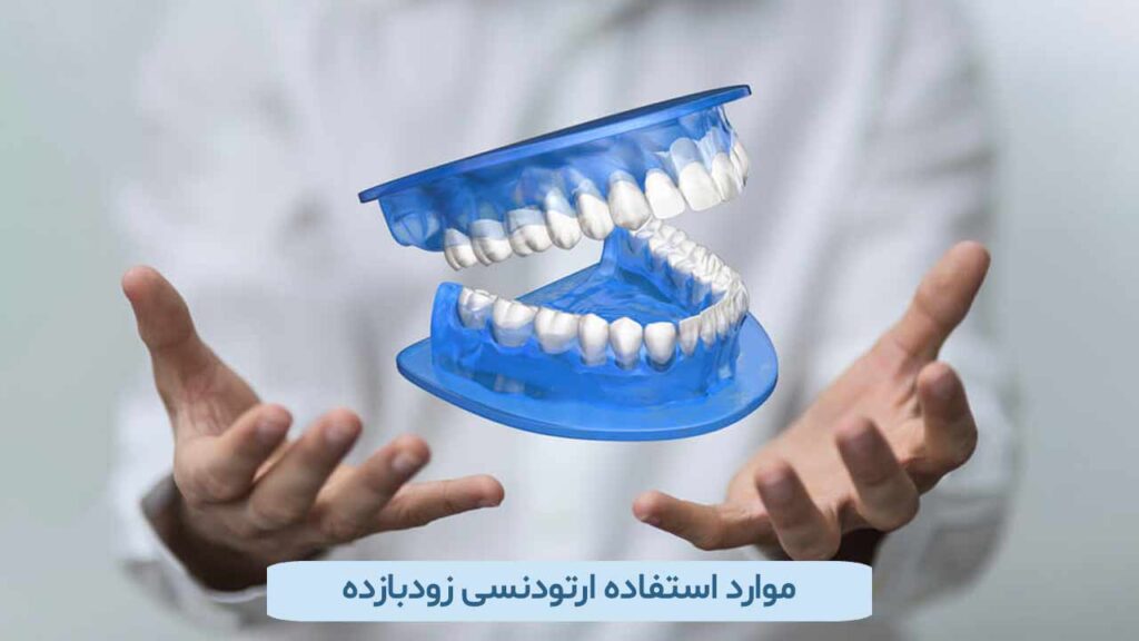 موارد استفاده ارتودنسی زودبازده