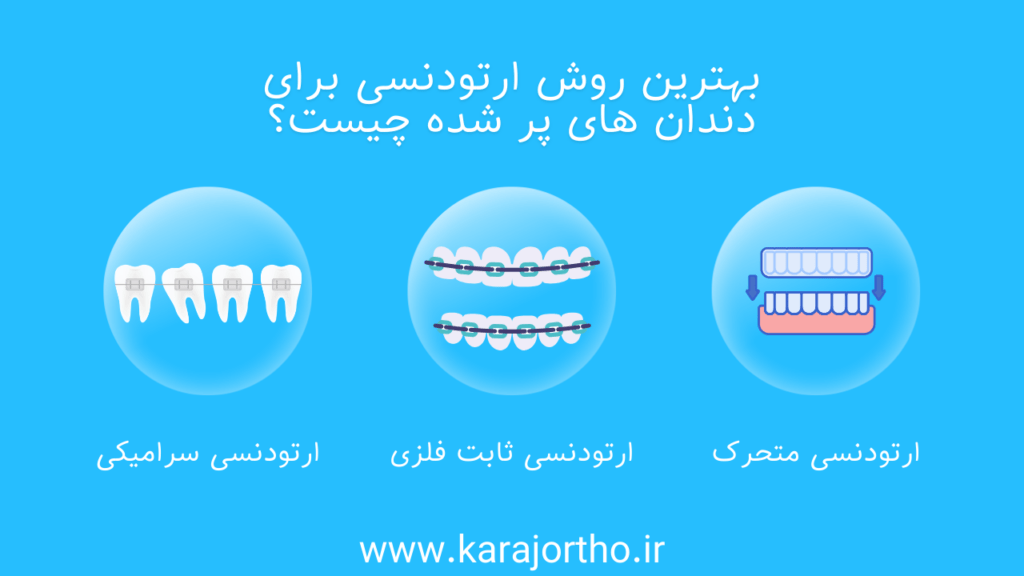 بهترین روش ارتودنسی برای دندان های پر شده چیست؟