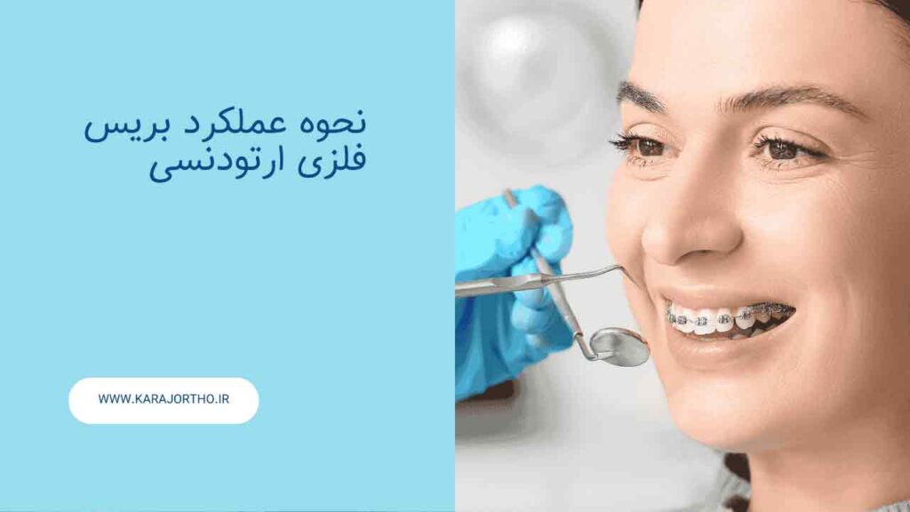 نحوه عملکرد بریس فلزی ارتودنسی